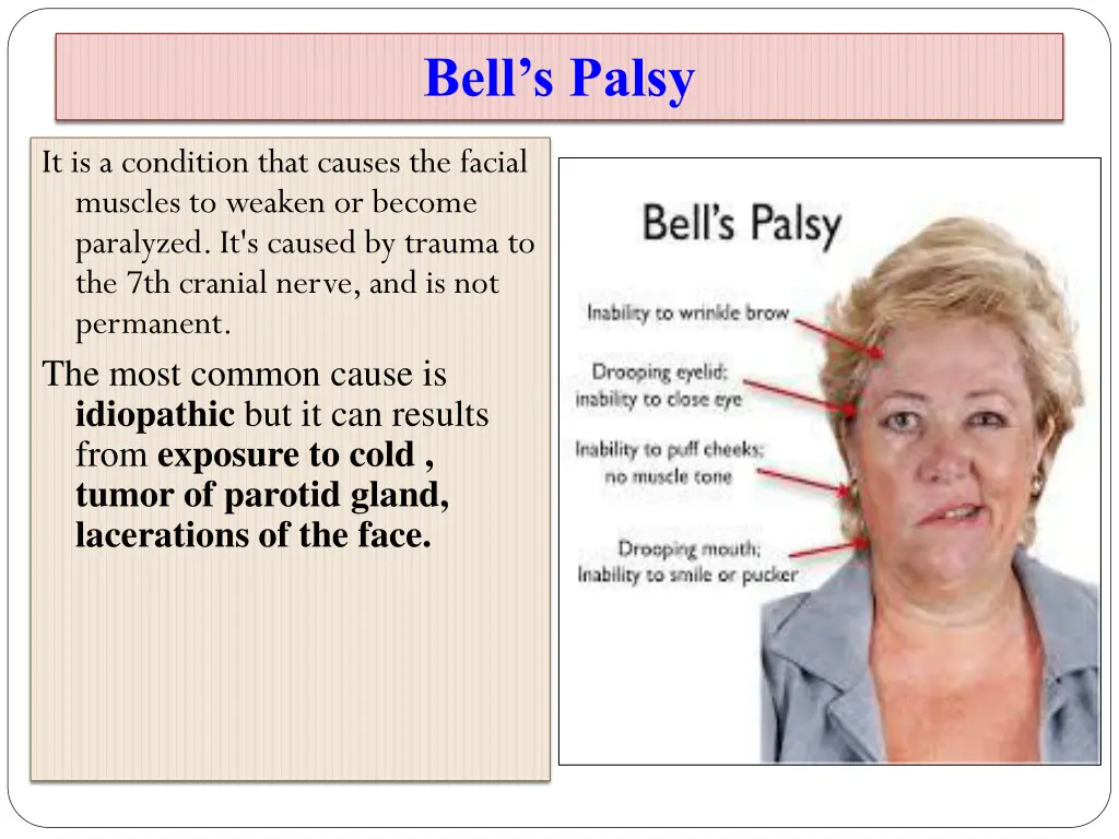 bell s palsy