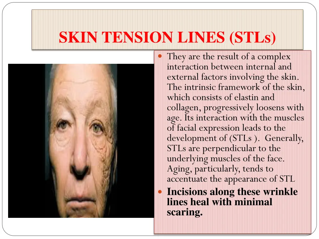 skin tension lines stls