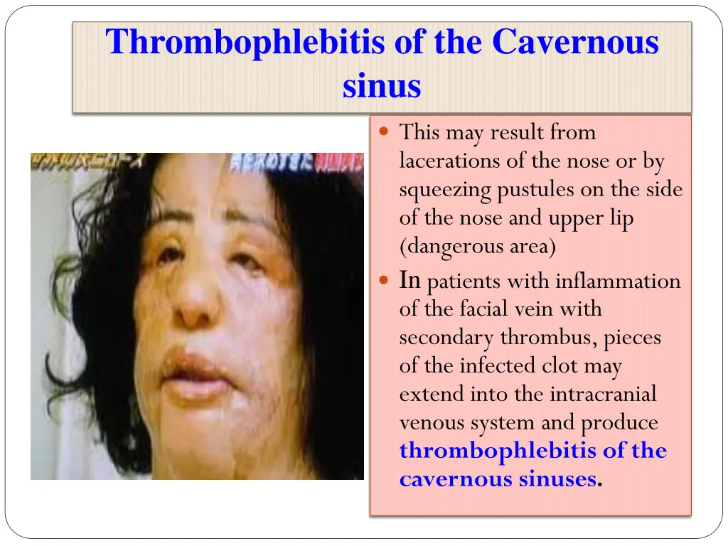 thrombophlebitis of the cavernous sinus