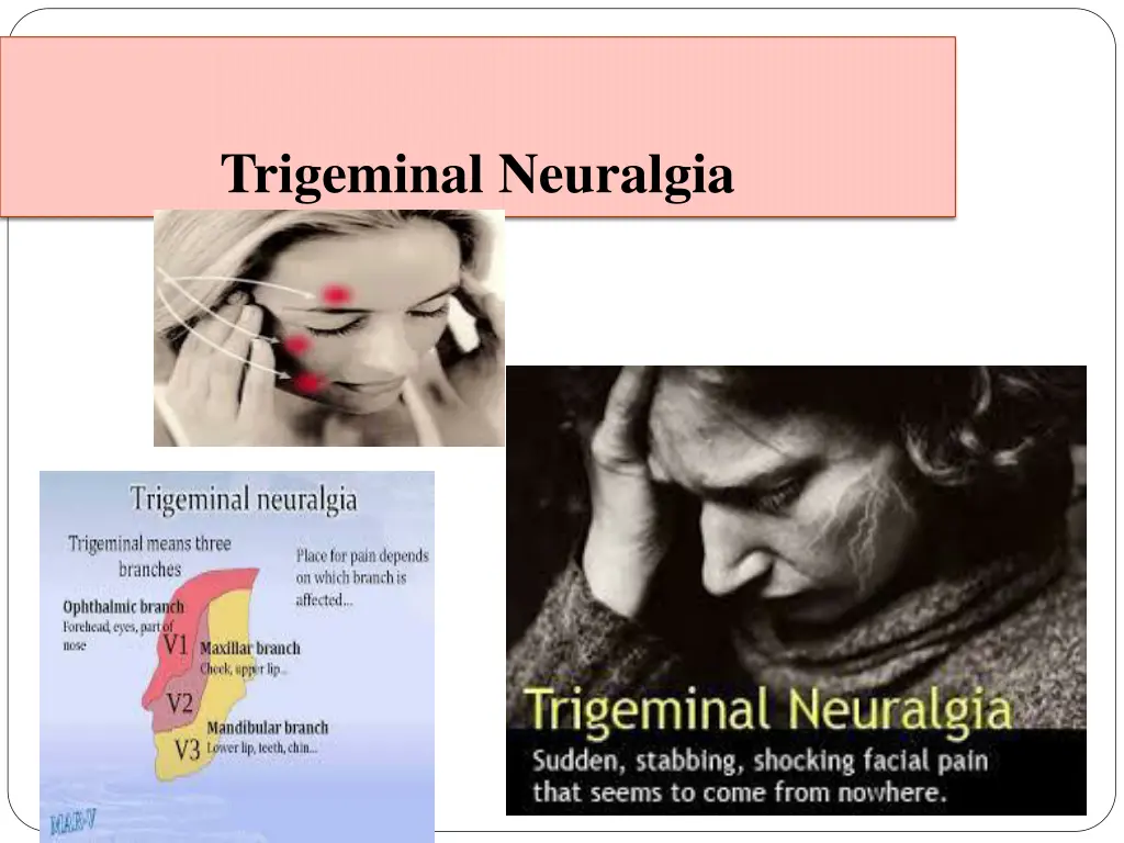 trigeminal neuralgia