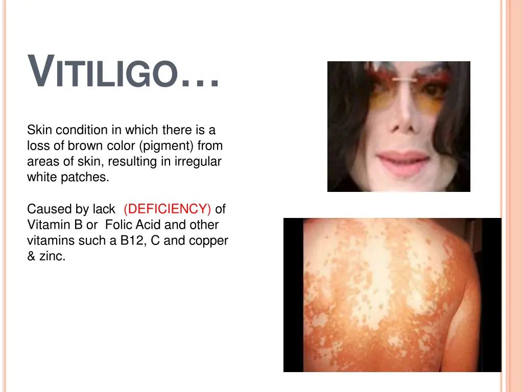 v itiligo