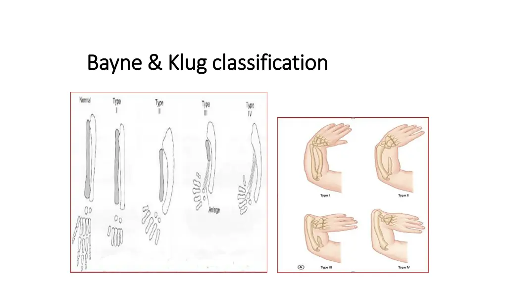 bayne klug classification bayne klug