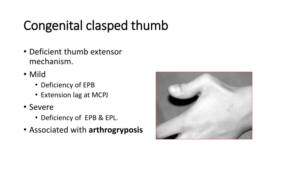 congenital clasped thumb congenital clasped thumb