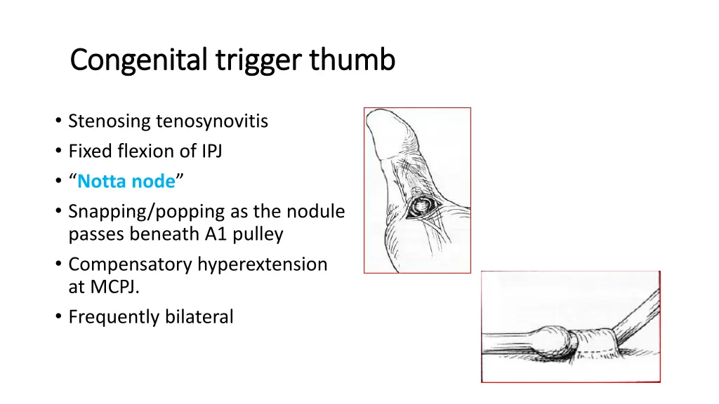 congenital trigger thumb congenital trigger thumb