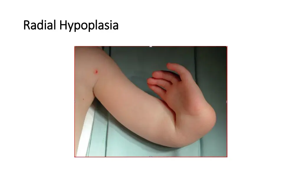 radial hypoplasia radial hypoplasia