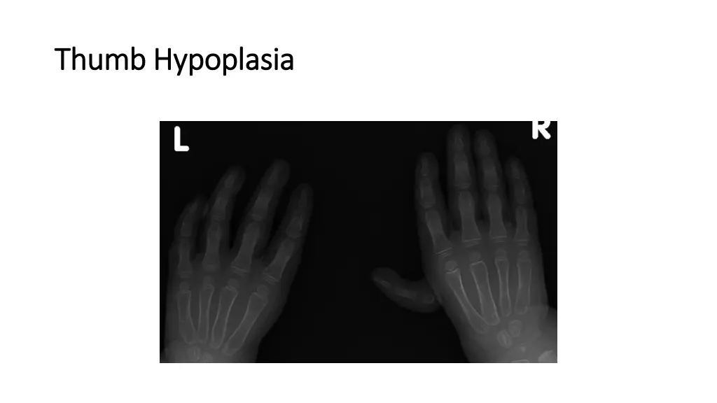 thumb hypoplasia thumb hypoplasia