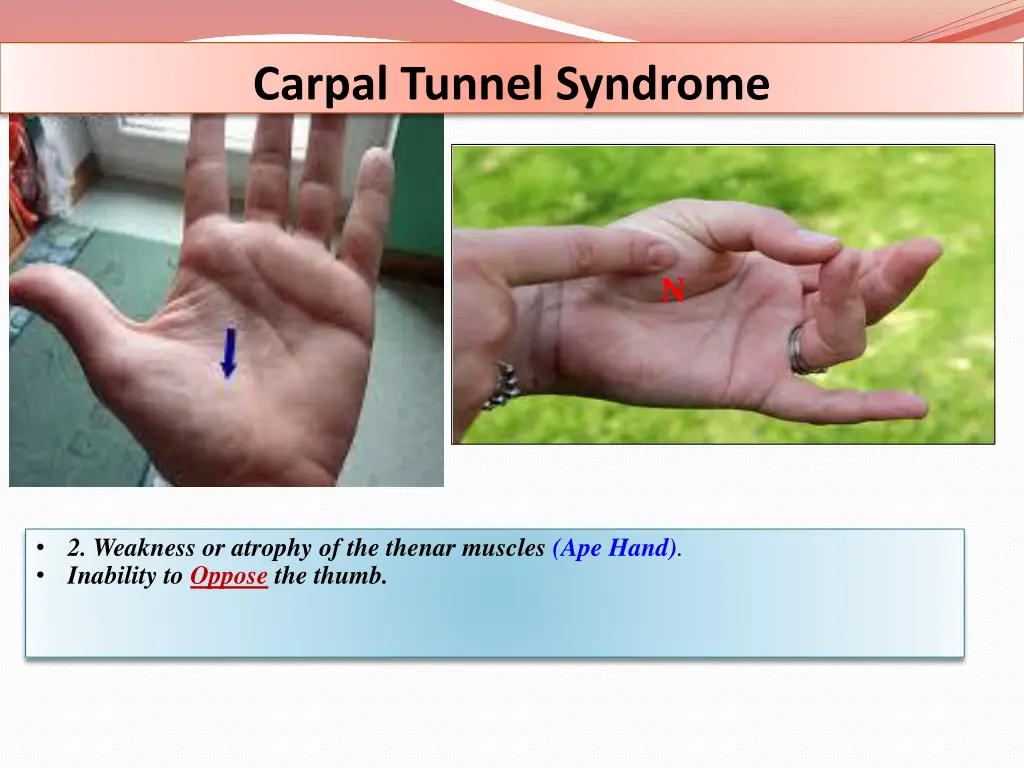 carpal tunnel syndrome 1