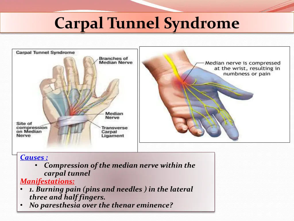 carpal tunnel syndrome