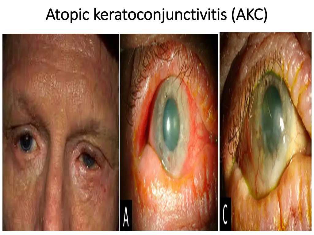 atopic atopic keratoconjunctivitis