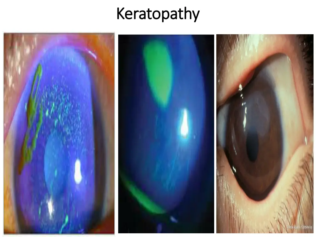 keratopathy keratopathy