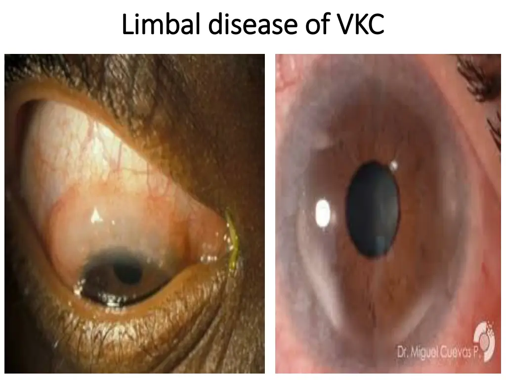 limbal limbal disease of vkc disease of vkc