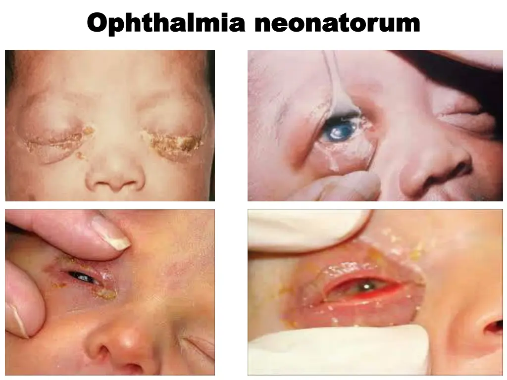 ophthalmia ophthalmia neonatorum