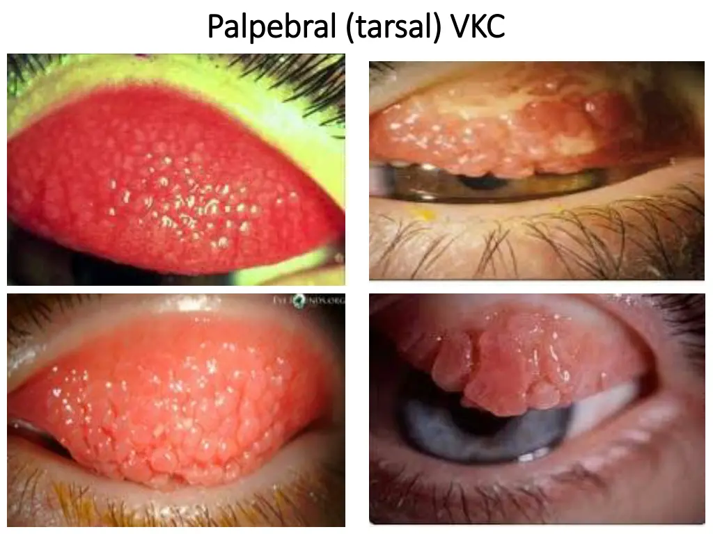 palpebral tarsal vkc palpebral tarsal vkc