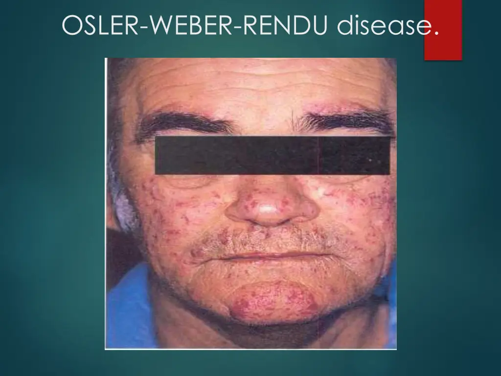 osler weber rendu disease