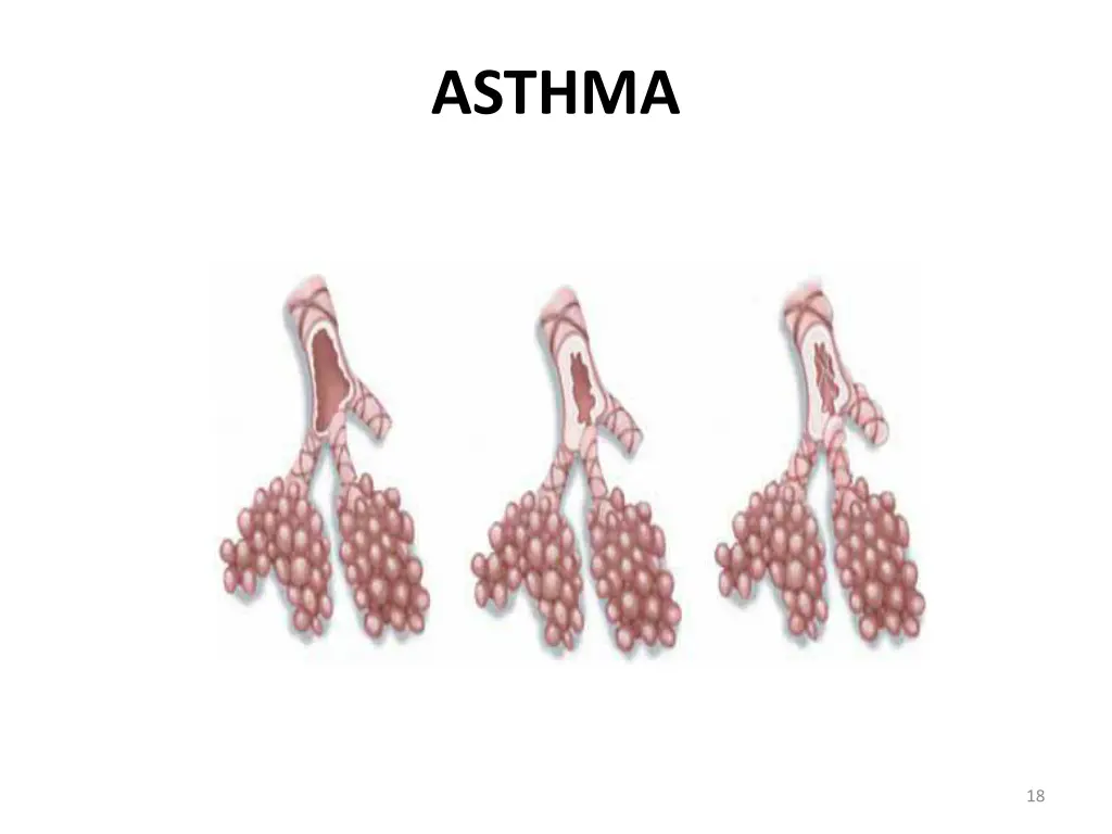 asthma 1