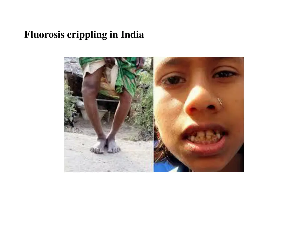 fluorosis crippling in india