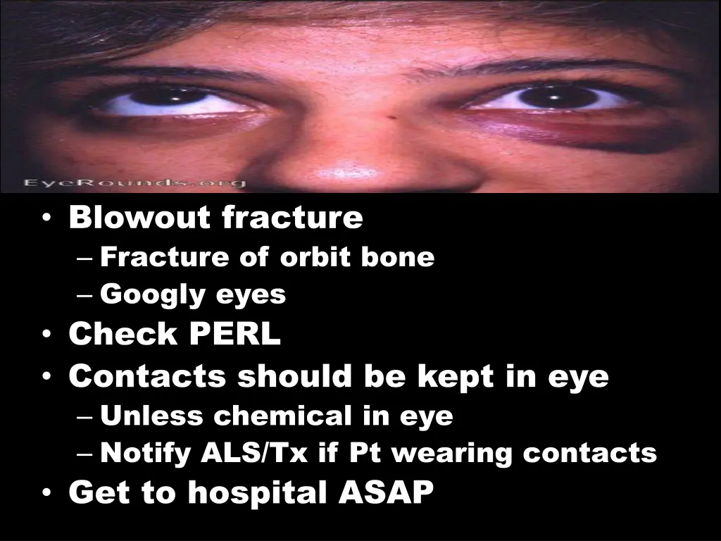 blowout fracture fracture of orbit bone googly