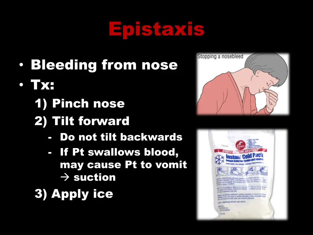 epistaxis