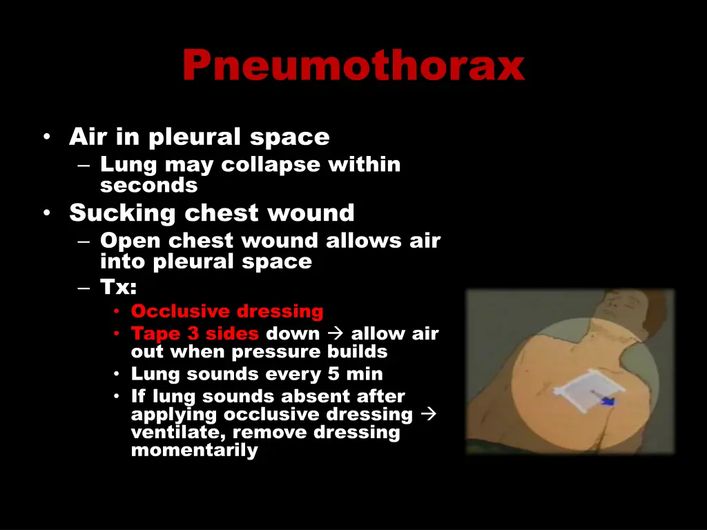 pneumothorax