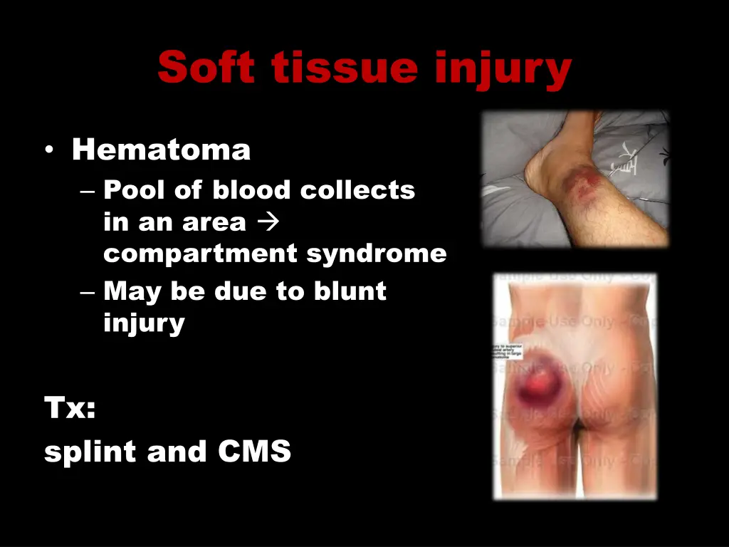 soft tissue injury