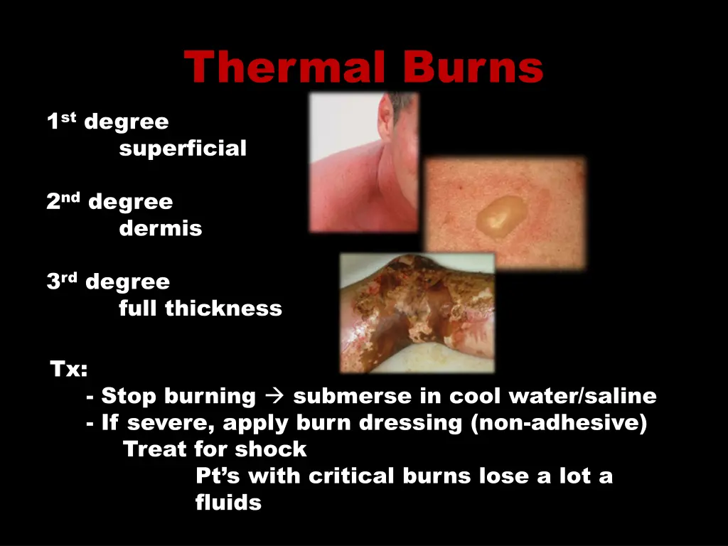 thermal burns