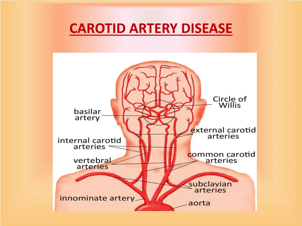 carotid artery disease