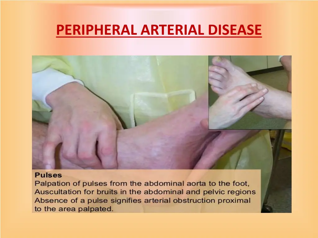 peripheral arterial disease 10