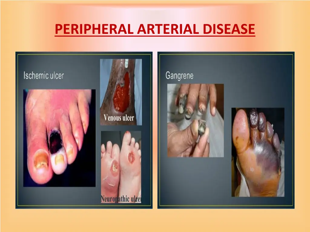 peripheral arterial disease 11