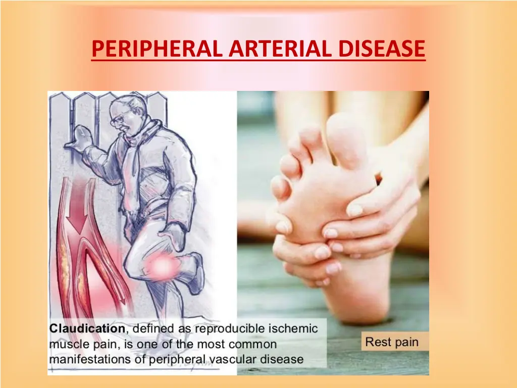 peripheral arterial disease 3