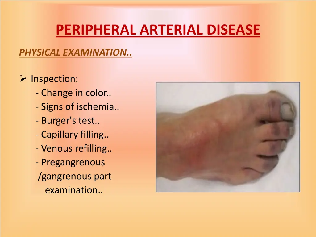 peripheral arterial disease 6