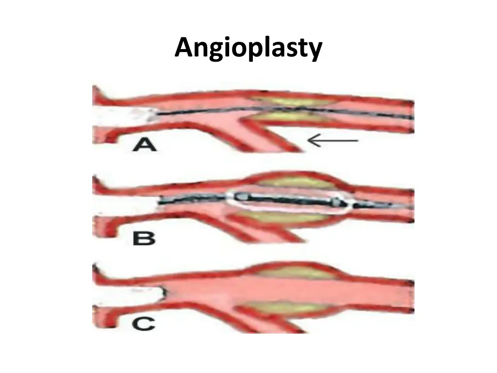 angioplasty