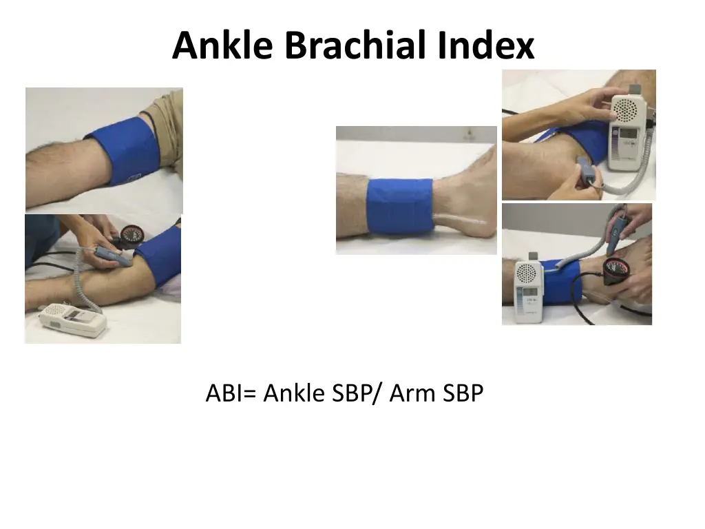 ankle brachial index