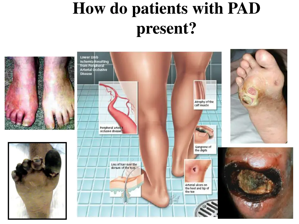 how do patients with pad present