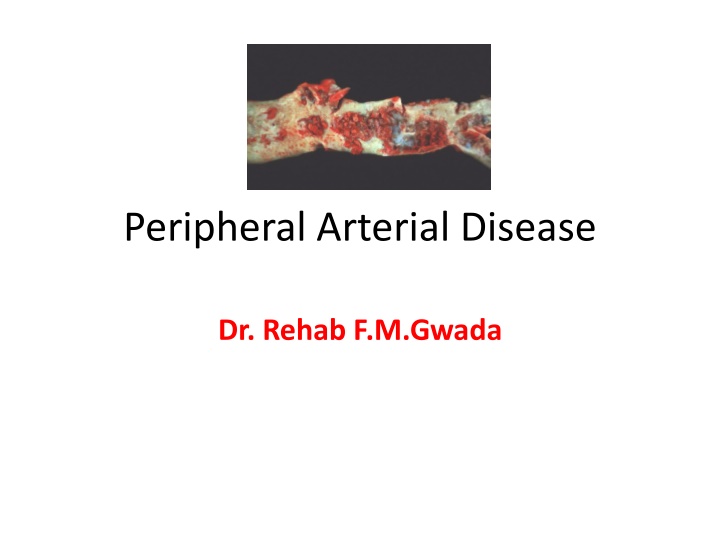 peripheral arterial disease