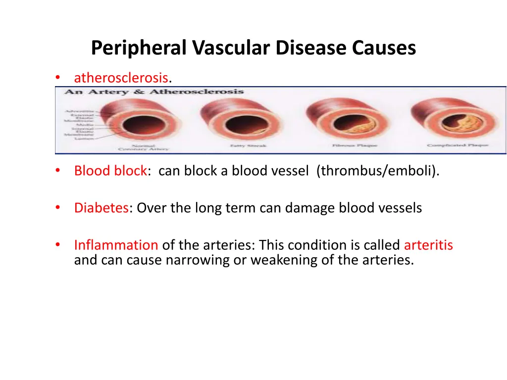 peripheral vascular disease causes