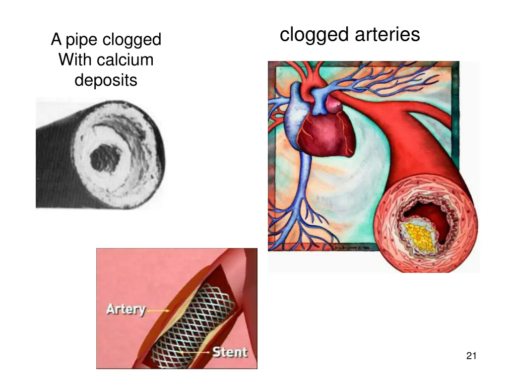 clogged arteries