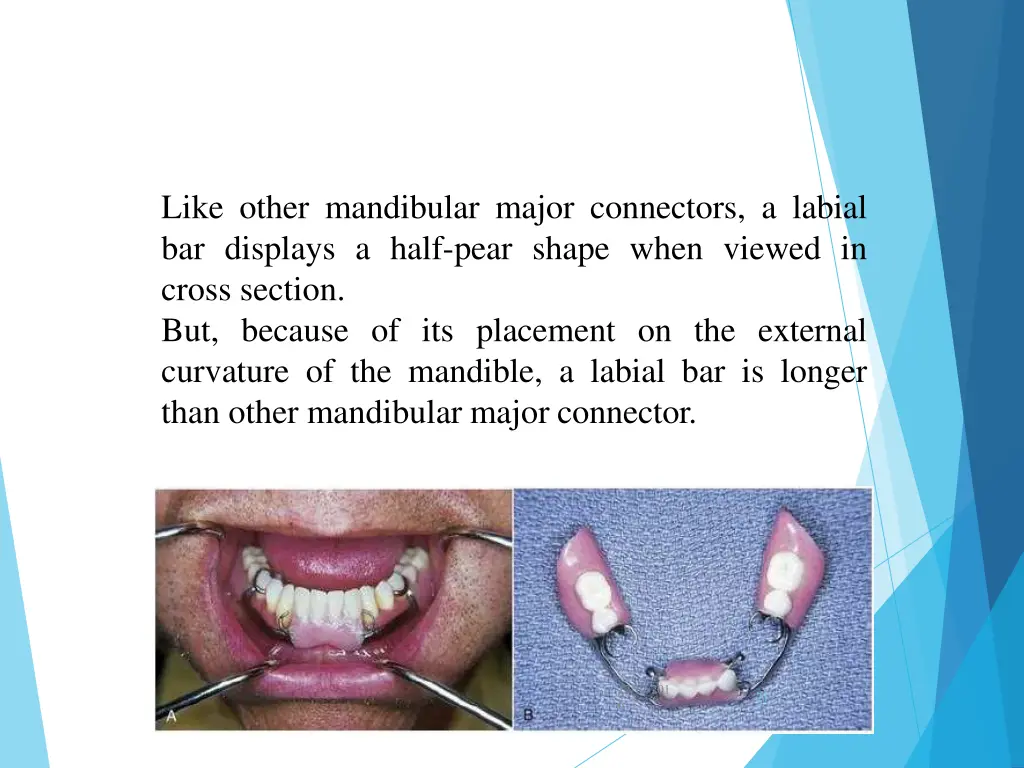 like other mandibular major connectors a labial