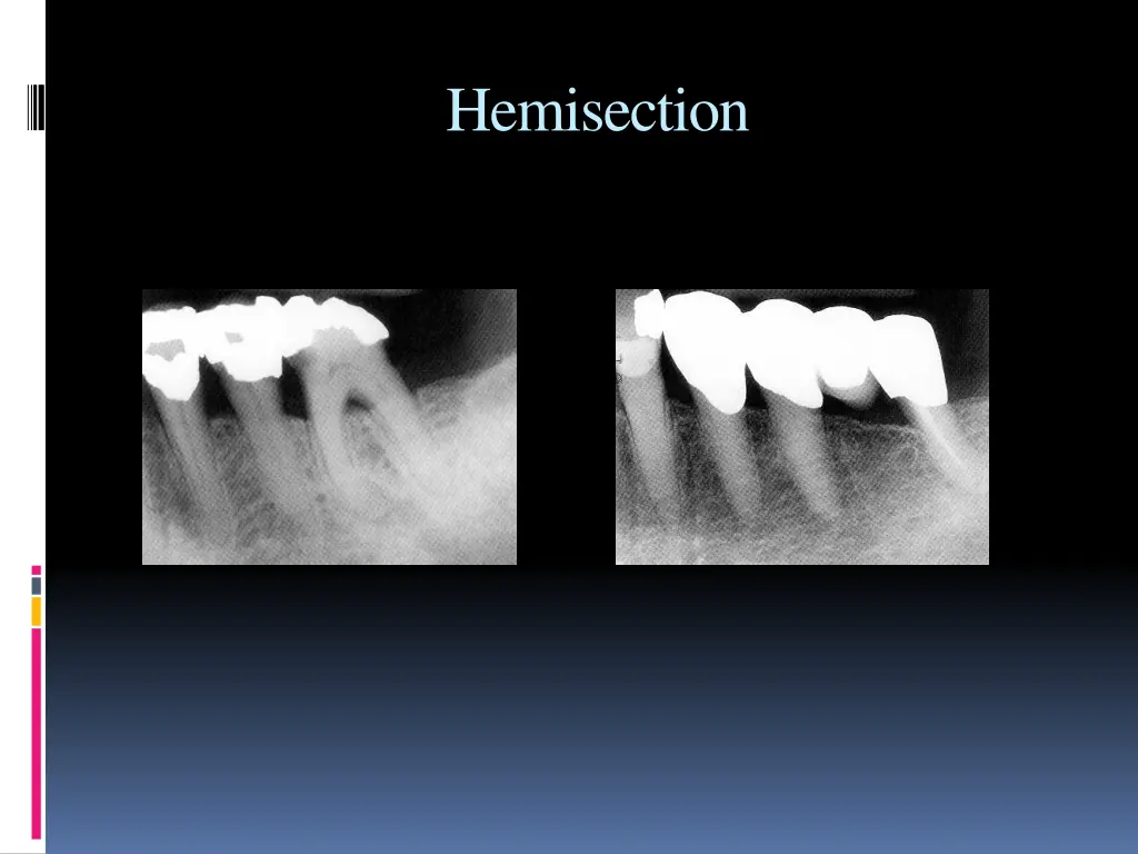 hemisection 1