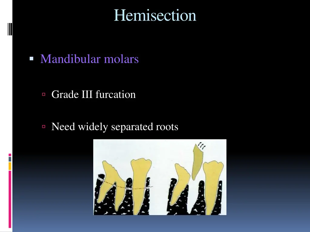 hemisection