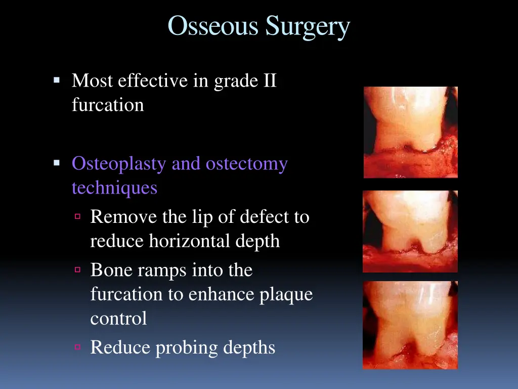 osseous surgery