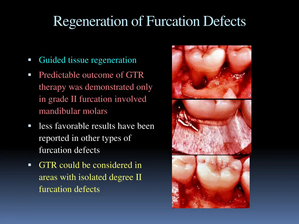 regeneration of furcation defects