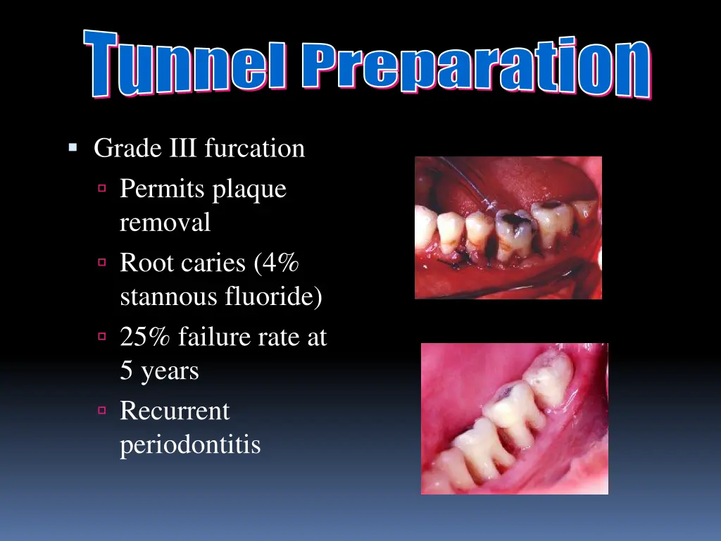 tunnel preparation