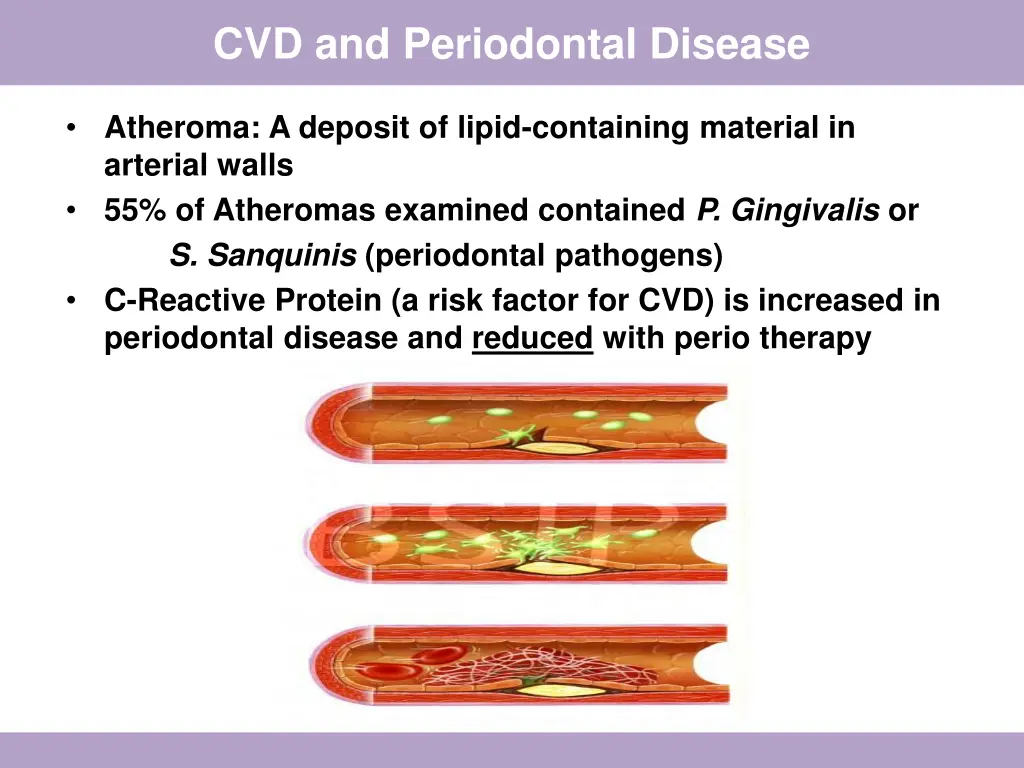 cvd and periodontal disease