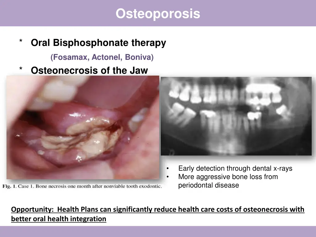 osteoporosis