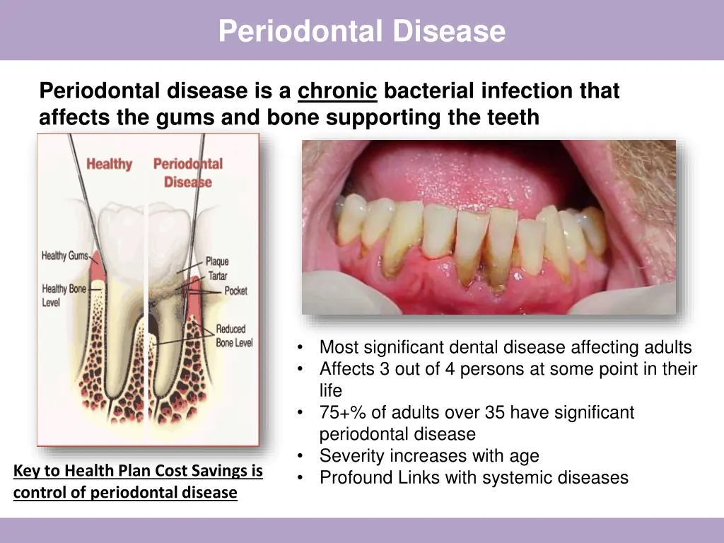 periodontal disease