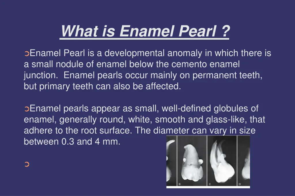 what is enamel pearl