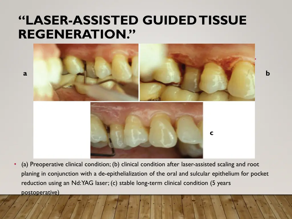 laser assisted guided tissue regeneration