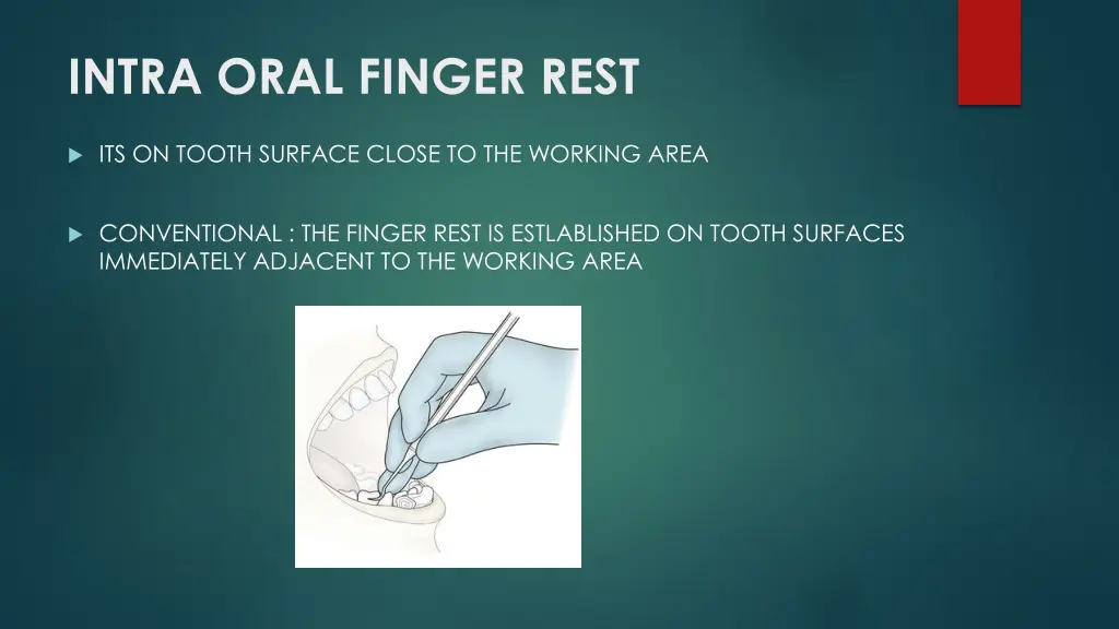 intra oral finger rest