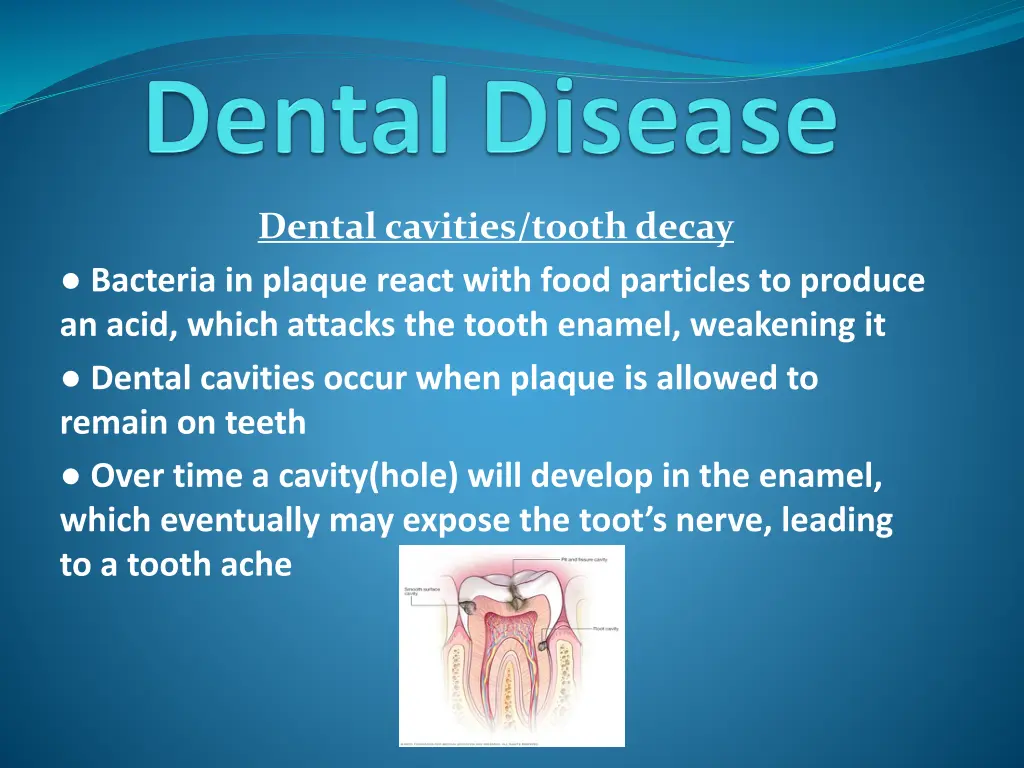 dental cavities tooth decay bacteria in plaque