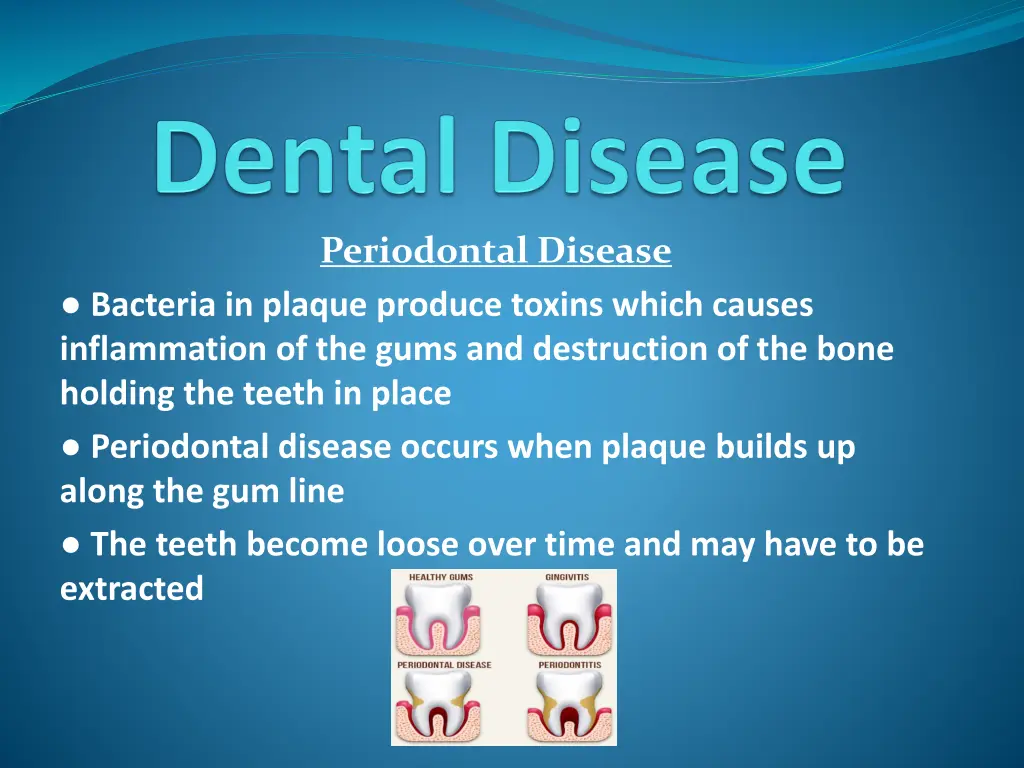 periodontal disease